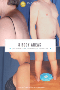 8 Areas You Didn’t Know You Could Get Lipo