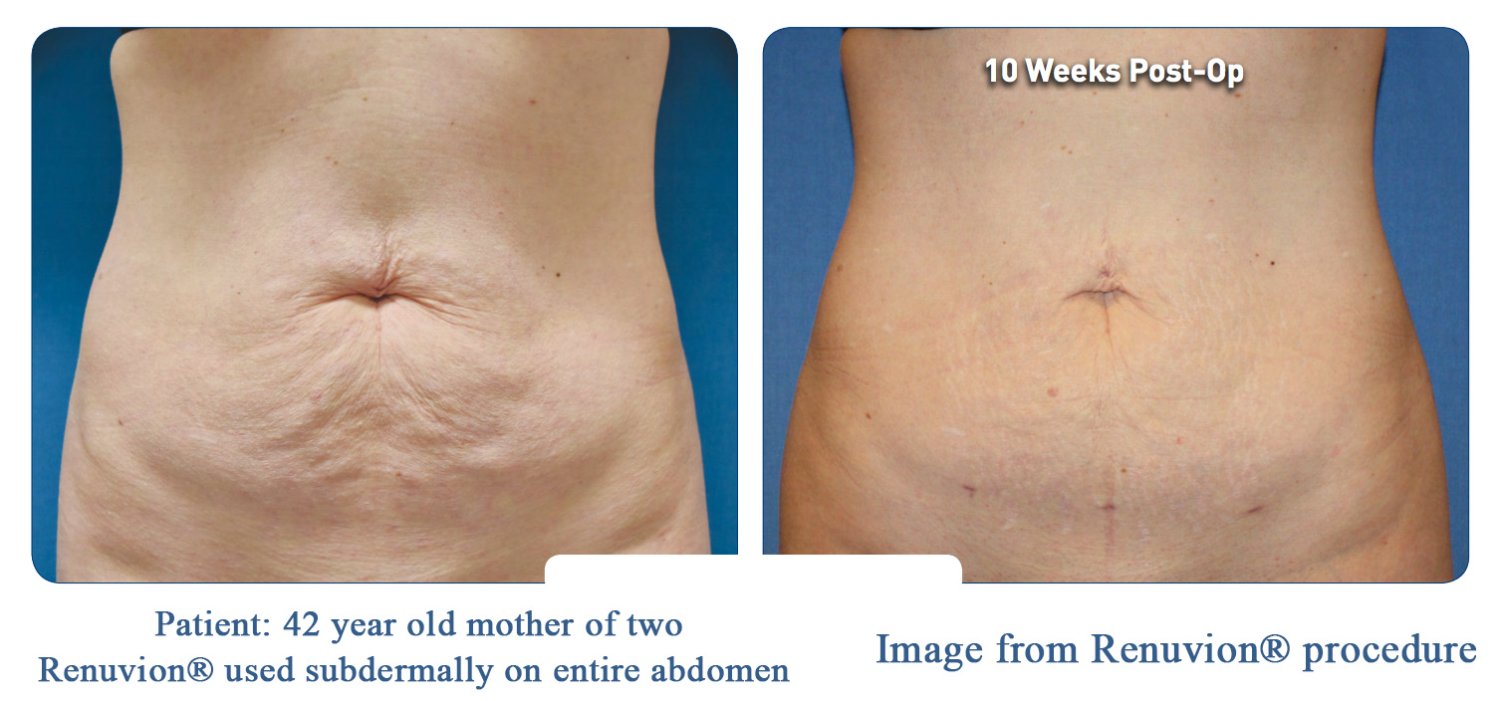 Omaha Liposuction Renuvion Skin tighening Lipo before and after