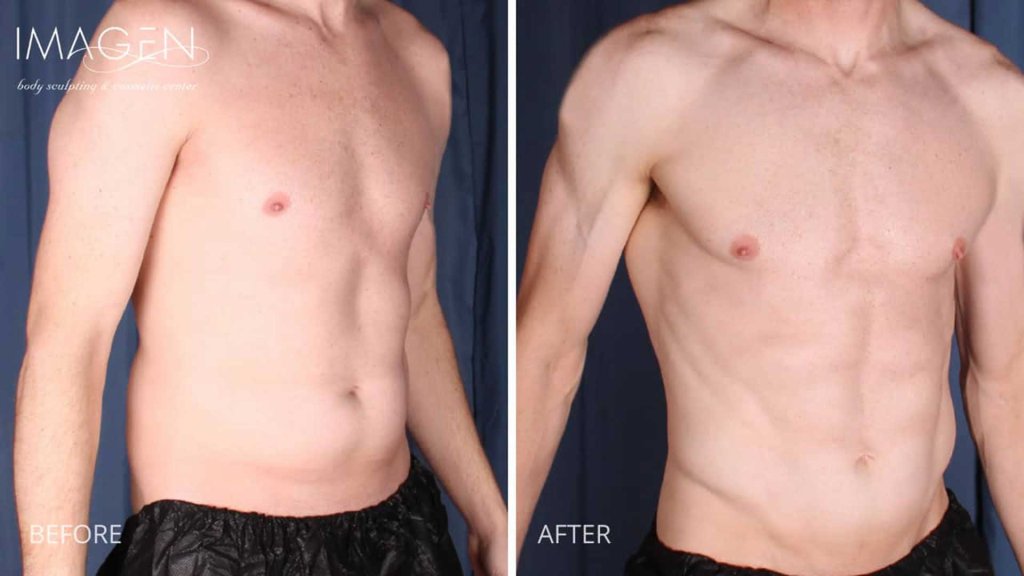 Before and after hi-def abdominal liposuction at Imagen