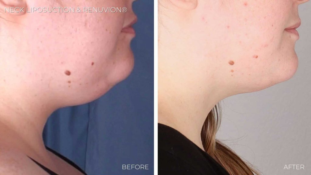 Before and after neck liposuction with Renuvion at Imagen