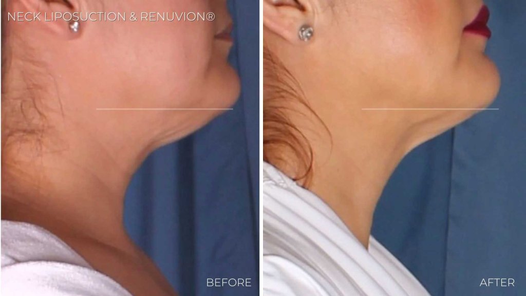 Before and after Renuvion skin tightening on the neck