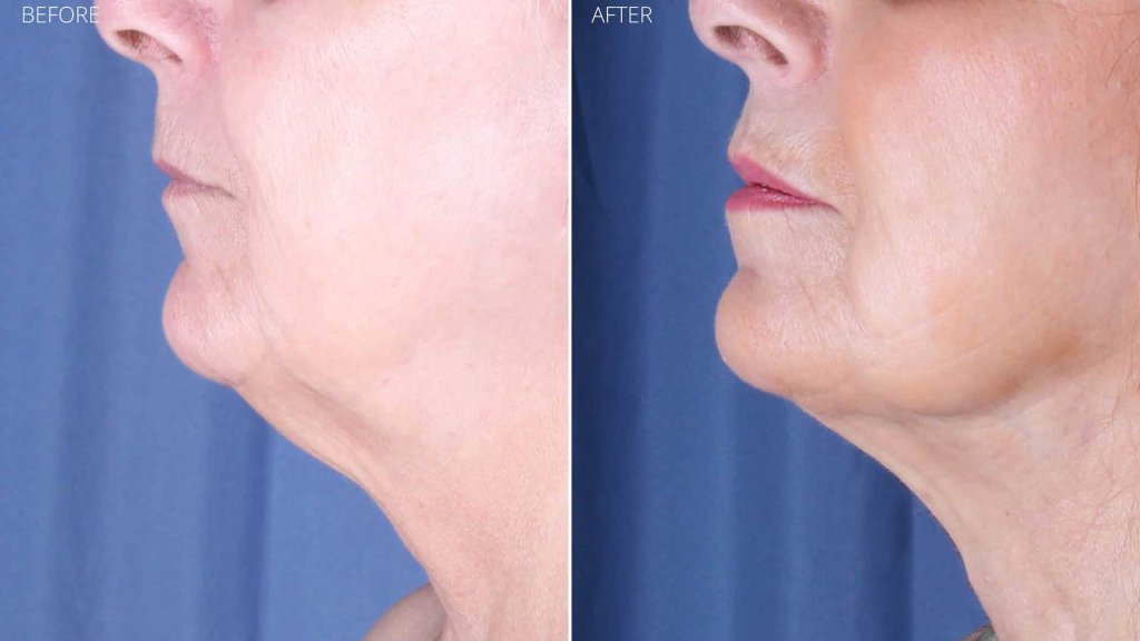 Before and after neck liposuction with Renuvion