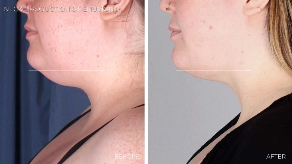 Before and after SmartLipo laser liposuction of the neck