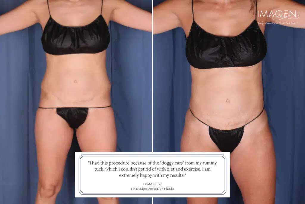 Imagen patient testimonial about SmartLipo with Renuvion
