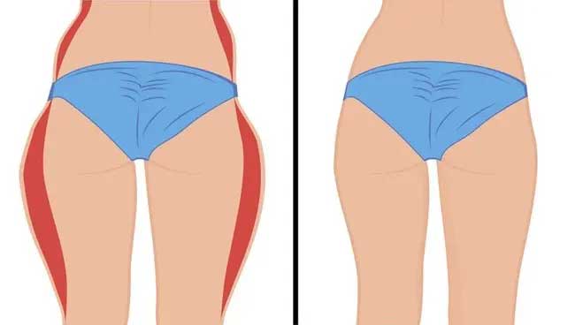 Lipedema liposuction treatment at Imagen in Omaha