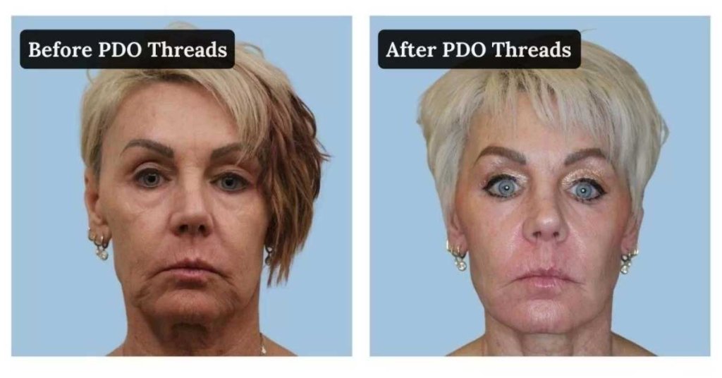 Before and after a PDO thread lift along the jawline
