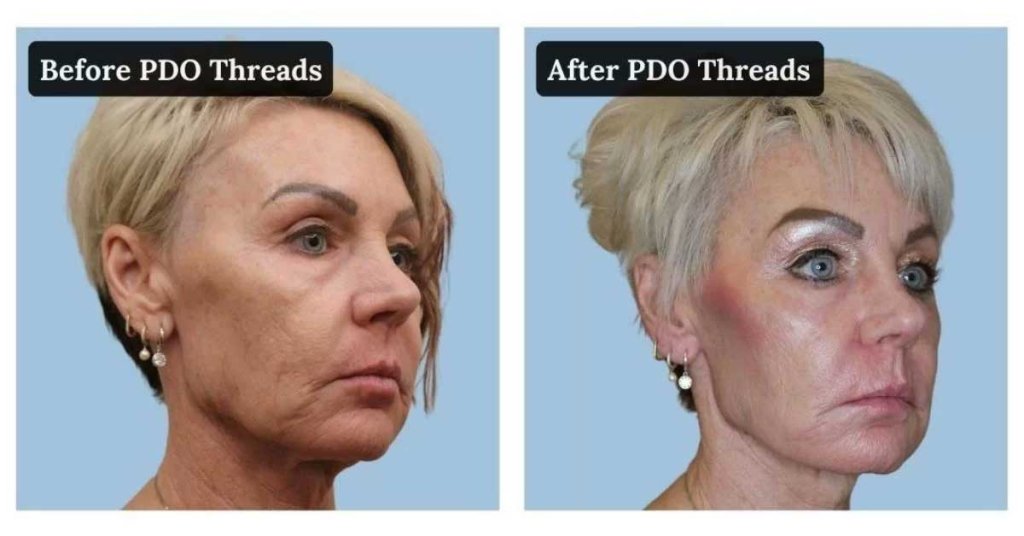 Before and after a PDO thread lift for sagging jawline skin