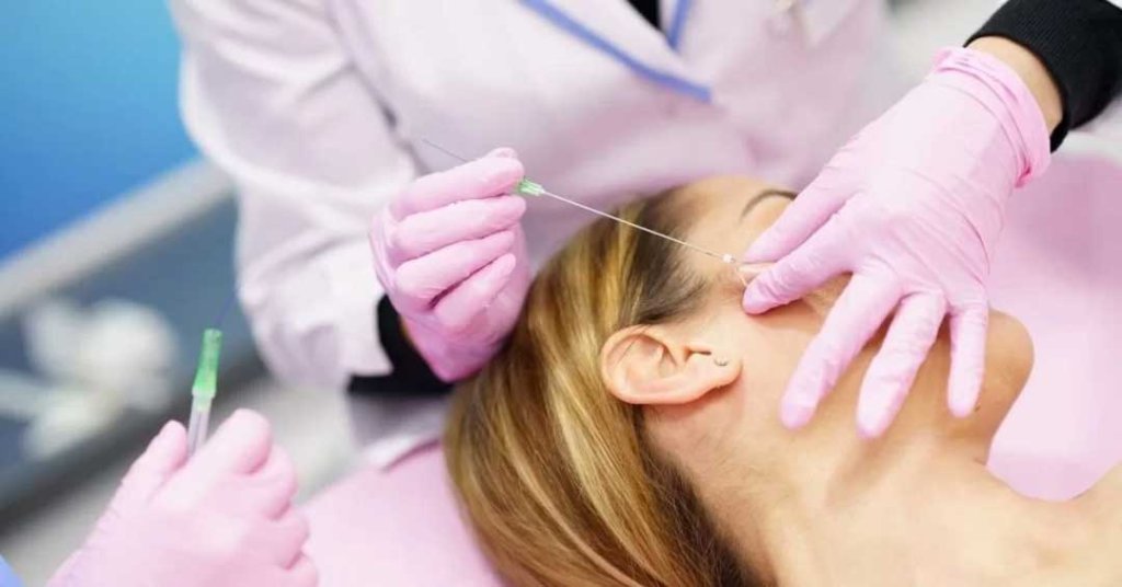 PDO thread lift treatment for the jawline