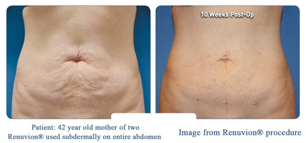 Before and after abdomen following SmartLipo with Renuvion