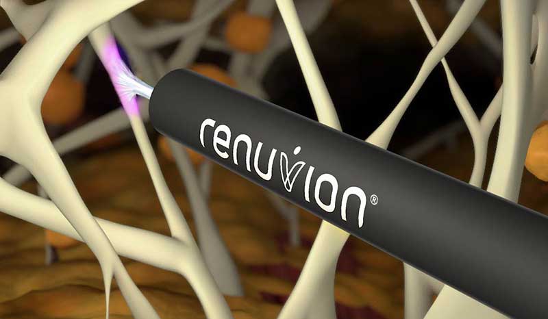 Illustration of how Renuvion heats and tightens tissue